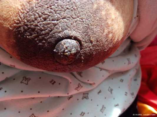 产妇乳头皲裂怎么,孕期乳头干裂是什么原因造成的 第1张 产妇乳头皲裂怎么,孕期乳头干裂是什么原因造成的 第1张