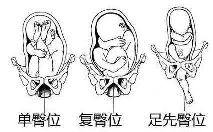 胎儿臀围(胎位臂位是什么意思) 第2张 胎儿臀围(胎位臂位是什么意思) 第2张
