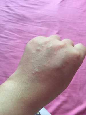 孕期身上痒怎么办（孕期身上痒怎么办越挠越痒,特别是晚上）  第3张