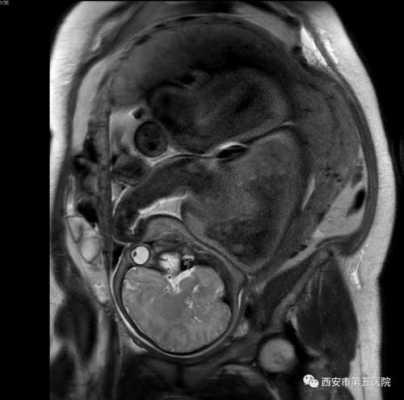 胎儿mri（核磁共振有辐射吗？孕妇可以做吗）  第1张