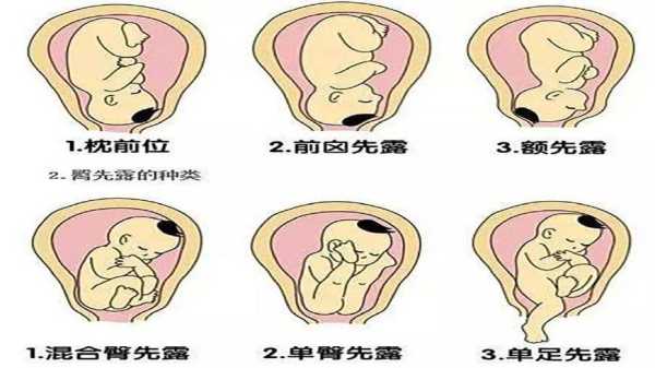 胎儿左枕位(请问左枕后位是什么意思) 第2张 胎儿左枕位(请问左枕后位是什么意思) 第2张