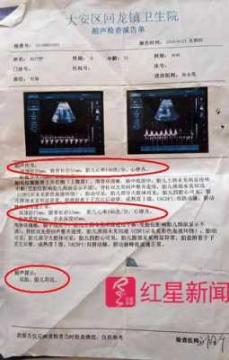 B超数据上股骨长是什么意思,胎儿股骨长度与孕周对照表 第2张 B超数据上股骨长是什么意思,胎儿股骨长度与孕周对照表 第2张