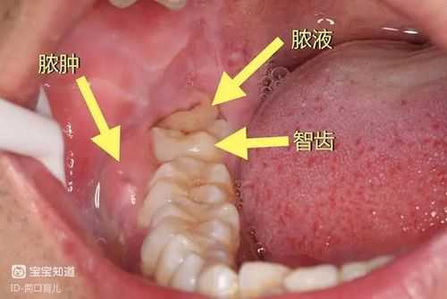 孕期智齿发炎怎么办(孕期智齿发炎怎么办,一边脸都肿了) 第1张 孕期智齿发炎怎么办(孕期智齿发炎怎么办,一边脸都肿了) 第1张