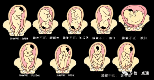 枕后位缩写,胎儿枕后位是什么意思 第2张 枕后位缩写,胎儿枕后位是什么意思 第2张
