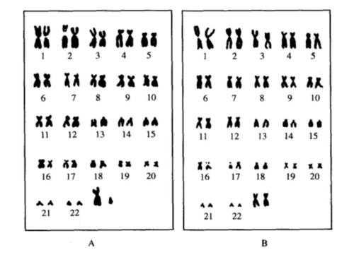 胎儿染色体检查(检查染色体是怎么检查的呢?怀孕早期时候了,必须检查哪些的呢) 第2张 胎儿染色体检查(检查染色体是怎么检查的呢?怀孕早期时候了,必须检查哪些的呢) 第2张