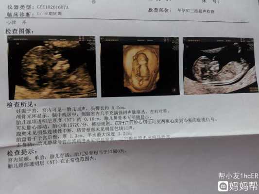 颈后透明层厚度多大正常,胎儿颈项透明层厚度正常值 第2张 颈后透明层厚度多大正常,胎儿颈项透明层厚度正常值 第2张