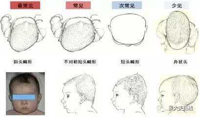胎儿头扁(胎儿头扁长属于畸形吗) 第2张 胎儿头扁(胎儿头扁长属于畸形吗) 第2张