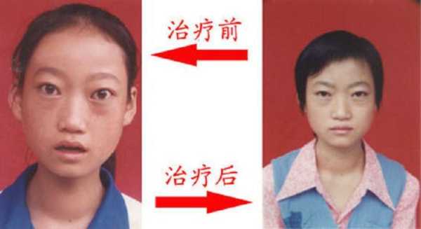 甲亢对胎儿的影响有哪些,老公有甲亢影响胎儿吗 第3张 甲亢对胎儿的影响有哪些,老公有甲亢影响胎儿吗 第3张