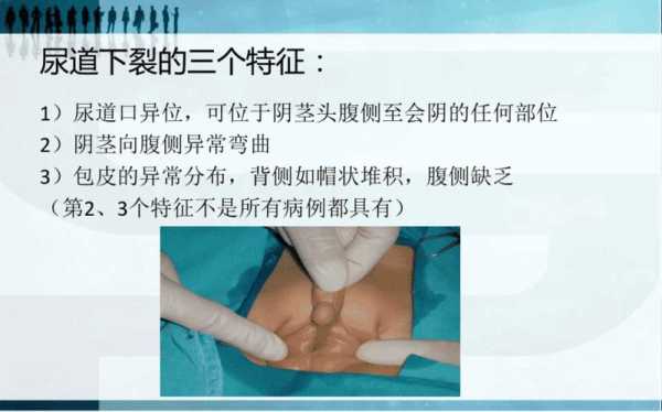 胎儿尿道下裂(尿道下裂是什么原因) 第2张 胎儿尿道下裂(尿道下裂是什么原因) 第2张