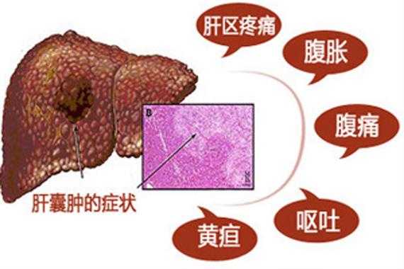 胎儿肝囊肿(胎儿肝囊肿是什么原因引起的) 第1张 胎儿肝囊肿(胎儿肝囊肿是什么原因引起的) 第1张
