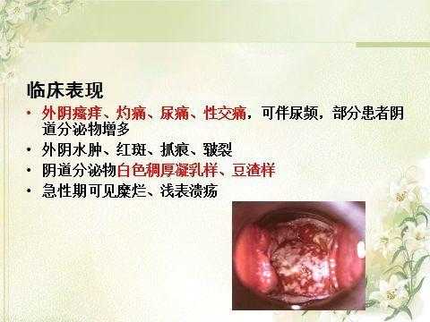 孕期阴道炎反复(孕期霉菌性阴炎反反复复怎么办) 第1张 孕期阴道炎反复(孕期霉菌性阴炎反反复复怎么办) 第1张
