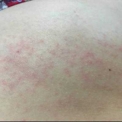 怀孕期间过敏怎么办(怀孕期间过敏怎么办?) 第1张 怀孕期间过敏怎么办(怀孕期间过敏怎么办?) 第1张