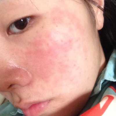 孕期脸过敏怎么办(孕妇过敏怎么自行缓解) 第1张 孕期脸过敏怎么办(孕妇过敏怎么自行缓解) 第1张