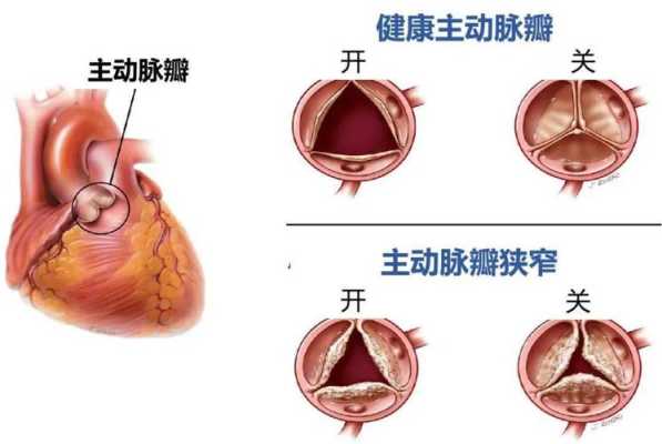什么是主动脉狭窄,胎儿主动脉狭窄是否要终止妊娠 第2张 什么是主动脉狭窄,胎儿主动脉狭窄是否要终止妊娠 第2张