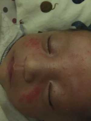 宝宝鼻子红肿怎么办,医生说胎宝宝鼻子大暗示什么 第2张 宝宝鼻子红肿怎么办,医生说胎宝宝鼻子大暗示什么 第2张