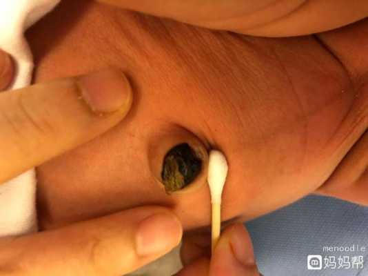 宝宝脐带有点红,搓肚子时发现出血了,怎么办?急急急,胎儿玩脐带妈妈会痛吗 第3张 宝宝脐带有点红,搓肚子时发现出血了,怎么办?急急急,胎儿玩脐带妈妈会痛吗 第3张
