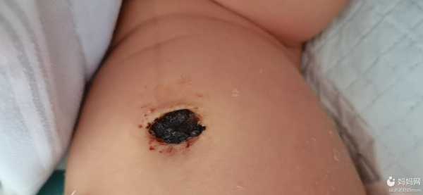 宝宝脐带有点红,搓肚子时发现出血了,怎么办?急急急,胎儿玩脐带妈妈会痛吗 第1张 宝宝脐带有点红,搓肚子时发现出血了,怎么办?急急急,胎儿玩脐带妈妈会痛吗 第1张