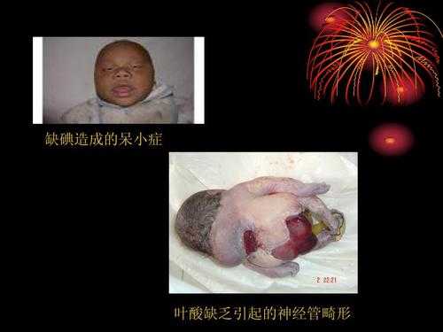 胎儿缺碘（胎儿缺碘）  第2张