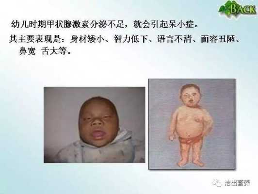 胎儿缺碘（胎儿缺碘）  第1张