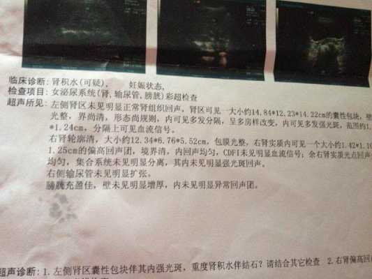 朋友怀孕去产检,查出胎儿肾积水,正常值是多少啊,胎儿肾积水严重吗?能治好吗 第2张 朋友怀孕去产检,查出胎儿肾积水,正常值是多少啊,胎儿肾积水严重吗?能治好吗 第2张