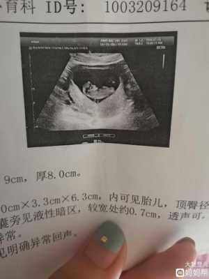 10周胎儿图片(已怀孕10周,还是没有尿频现象,正常吗) 第1张 10周胎儿图片(已怀孕10周,还是没有尿频现象,正常吗) 第1张