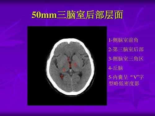 胎儿第三脑室(三脑室及双侧脑室大怎么回事) 第1张 胎儿第三脑室(三脑室及双侧脑室大怎么回事) 第1张