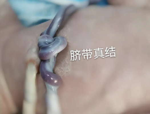 胎儿脐带打结(胎儿脐带打结是什么原因造成的) 第2张 胎儿脐带打结(胎儿脐带打结是什么原因造成的) 第2张