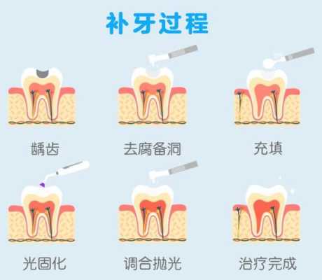 备孕期可以补牙吗(备孕期可以补牙吗补牙会打麻药对胎儿有影响吗) 第3张 备孕期可以补牙吗(备孕期可以补牙吗补牙会打麻药对胎儿有影响吗) 第3张