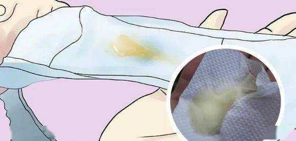 孕期流黄色分泌物(孕期流黄色分泌物怎么回事) 第3张 孕期流黄色分泌物(孕期流黄色分泌物怎么回事) 第3张