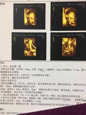 系统胎儿超声检查(系统彩超和四维彩超的区别) 第2张 系统胎儿超声检查(系统彩超和四维彩超的区别) 第2张