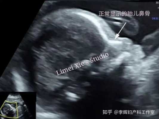 12周胎儿鼻骨缺失是畸形吗,胎儿鼻骨缺失是什么原因造成的  第3张