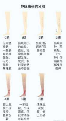 怀孕腿部静脉曲张怎么治疗,孕期静脉曲张如何缓解 第1张 怀孕腿部静脉曲张怎么治疗,孕期静脉曲张如何缓解 第1张