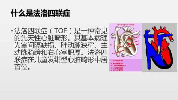 胎儿法洛四联症(胎儿法洛四联症能要吗) 第1张 胎儿法洛四联症(胎儿法洛四联症能要吗) 第1张