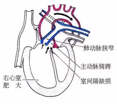 胎儿法洛四联症(胎儿法洛四联症能要吗) 第2张 胎儿法洛四联症(胎儿法洛四联症能要吗) 第2张