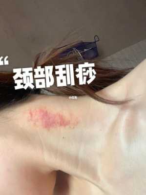 孕期能刮痧吗(孕期能刮痧吗脖子) 第2张 孕期能刮痧吗(孕期能刮痧吗脖子) 第2张
