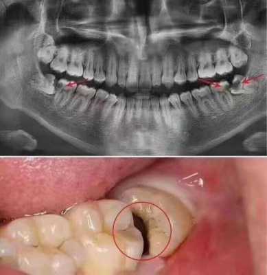 孕期能拔智齿吗(牙龈发炎可以拔智齿吗) 第2张 孕期能拔智齿吗(牙龈发炎可以拔智齿吗) 第2张
