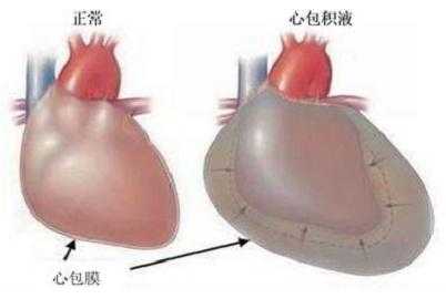 胎儿心包腔积液(胎儿心包腔积液是怎么导致的) 第1张 胎儿心包腔积液(胎儿心包腔积液是怎么导致的) 第1张