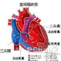 先天性心脏室缺会不会遗传,胎儿心脏室缺是什么原因造成的 第2张 先天性心脏室缺会不会遗传,胎儿心脏室缺是什么原因造成的 第2张