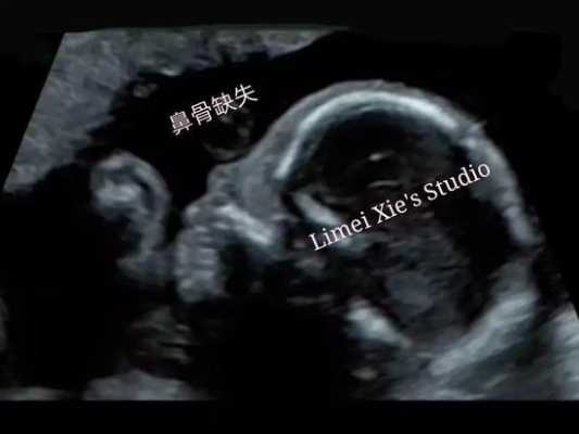 胎儿鼻骨图片(24周胎儿鼻骨长度标准) 第2张 胎儿鼻骨图片(24周胎儿鼻骨长度标准) 第2张
