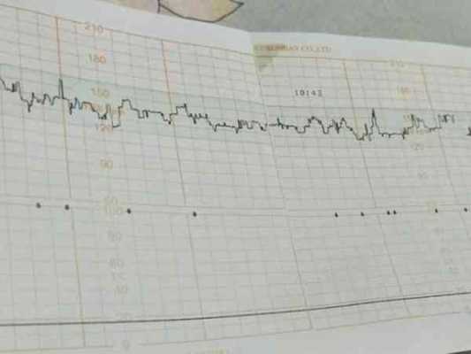 快走心率150正常吗,胎儿心跳150左右是男孩还是女孩 第3张 快走心率150正常吗,胎儿心跳150左右是男孩还是女孩 第3张