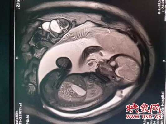 婴儿做磁共振怎么做,胎儿脑核磁共振能检查出什么  第2张