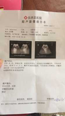 孕囊积液跟拉肚子有关吗,胎儿肠管积液是什么意思 第1张 孕囊积液跟拉肚子有关吗,胎儿肠管积液是什么意思 第1张