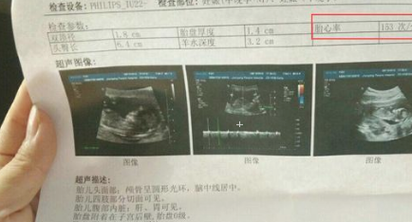 怀孕四十三天B超检查胎囊周围有液性暗区,该怎么办,孕期四周为一个月吗 第2张 怀孕四十三天B超检查胎囊周围有液性暗区,该怎么办,孕期四周为一个月吗 第2张