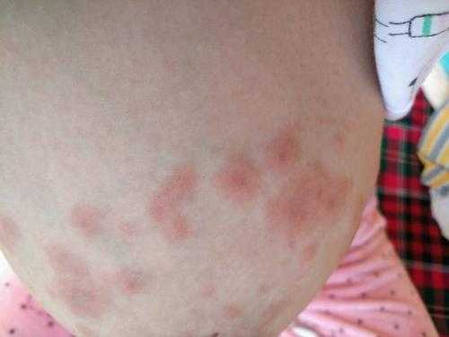 孕期湿疹了怎么办(孕妇阴部得了湿疹怎么办) 第3张 孕期湿疹了怎么办(孕妇阴部得了湿疹怎么办) 第3张
