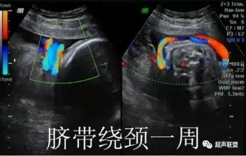 孕32周脐带绕颈一周怎么办?脐带绕颈,胎儿会窒息吗,胎儿脐带绕颈图片 彩超 第1张 孕32周脐带绕颈一周怎么办?脐带绕颈,胎儿会窒息吗,胎儿脐带绕颈图片 彩超 第1张