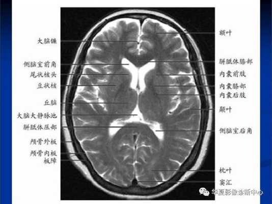 胎儿头颅磁共振(胎儿头颅磁共振最好多少周做) 第2张 胎儿头颅磁共振(胎儿头颅磁共振最好多少周做) 第2张