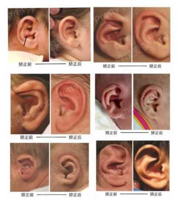 宝宝耳朵怎么会畸形的啊?怀孕期间需要注意哪些呢,畸形胎儿图片大全大图 第1张 宝宝耳朵怎么会畸形的啊?怀孕期间需要注意哪些呢,畸形胎儿图片大全大图 第1张