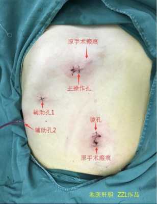 胎儿胆总管囊肿(胆总管囊肿术后可以恢复以前吗) 第2张 胎儿胆总管囊肿(胆总管囊肿术后可以恢复以前吗) 第2张