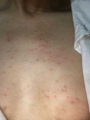 孕妇身上发痒是什么原因,孕期全身痒怎么回事儿 第2张 孕妇身上发痒是什么原因,孕期全身痒怎么回事儿 第2张