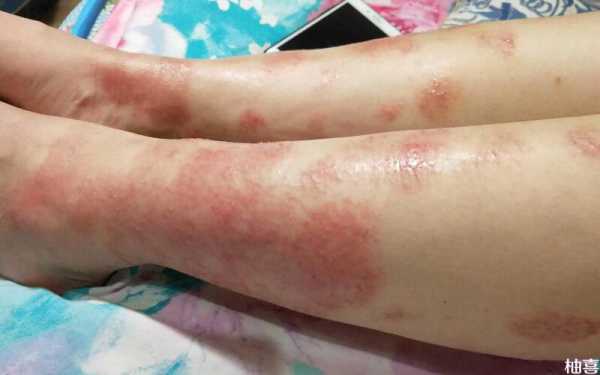 孕妇身上发痒是什么原因,孕期全身痒怎么回事儿 第1张 孕妇身上发痒是什么原因,孕期全身痒怎么回事儿 第1张